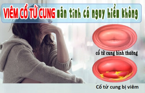 Viêm cổ tử cung mãn tính có nguy hiểm không? 